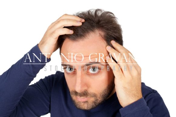 Download Man Controls Hair Loss - Hair loss Collection